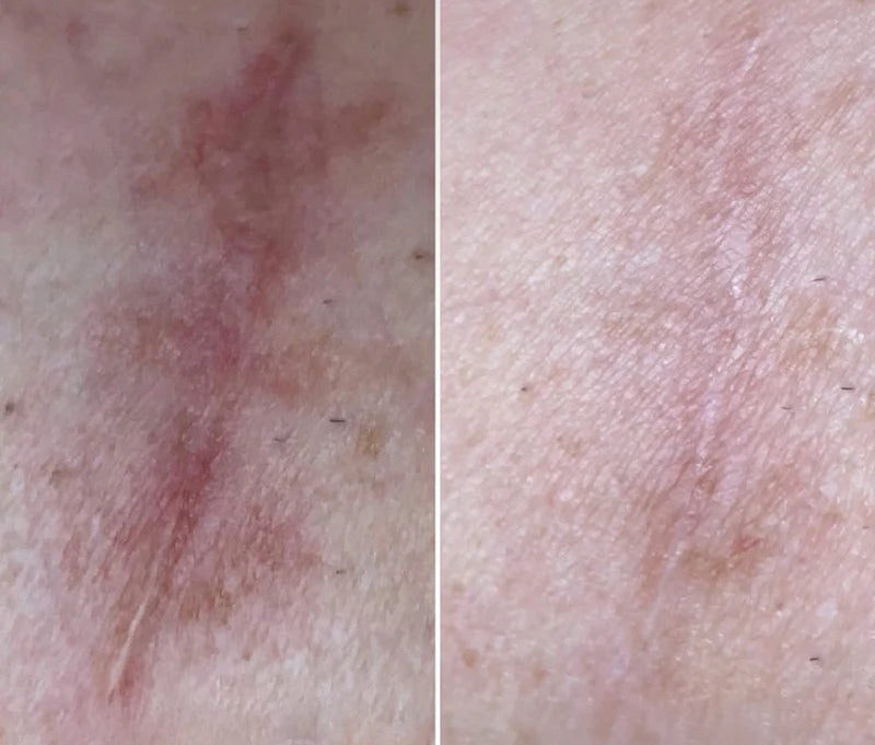 2 Patchs soin de la cicatrice à l'Aloé Vera réutilisable