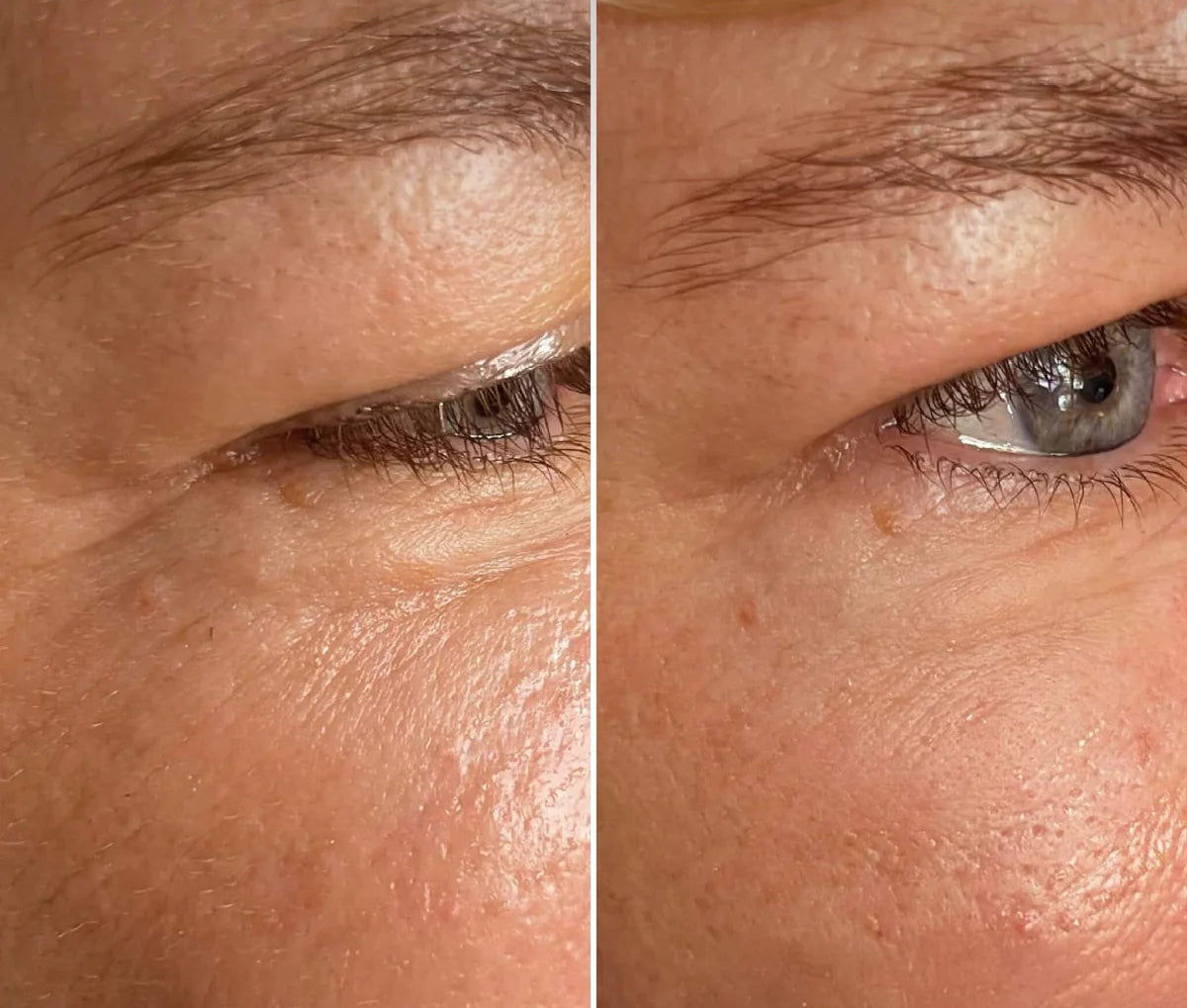 2 Patchs régénérant yeux et tempes à l'éctoïne réutilisable