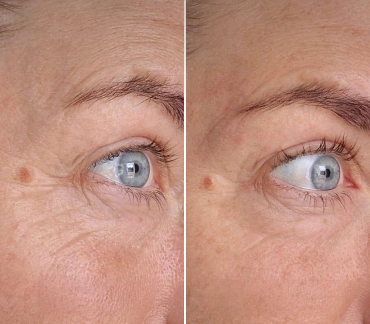 2 Patchs hydratant yeux et tempes à l'acide hyaluronique réutilisable