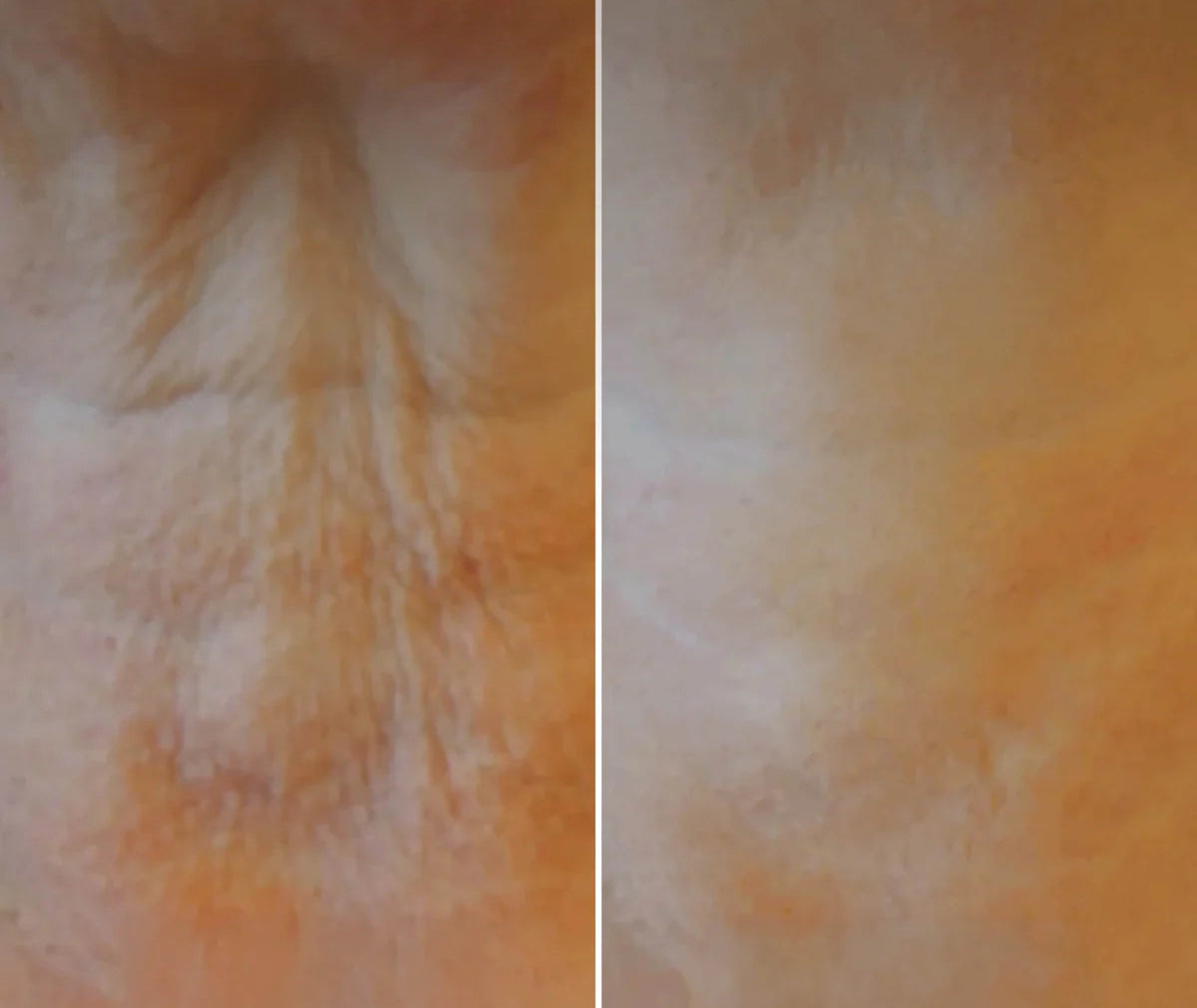 1 Patch hydratant cou à l'acide hyaluronique réutilisable